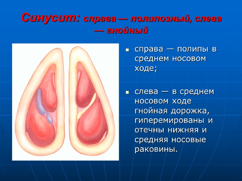 Синусит: справа — полипозный, слева — гнойный справа — полипы в среднем носовом ходе;